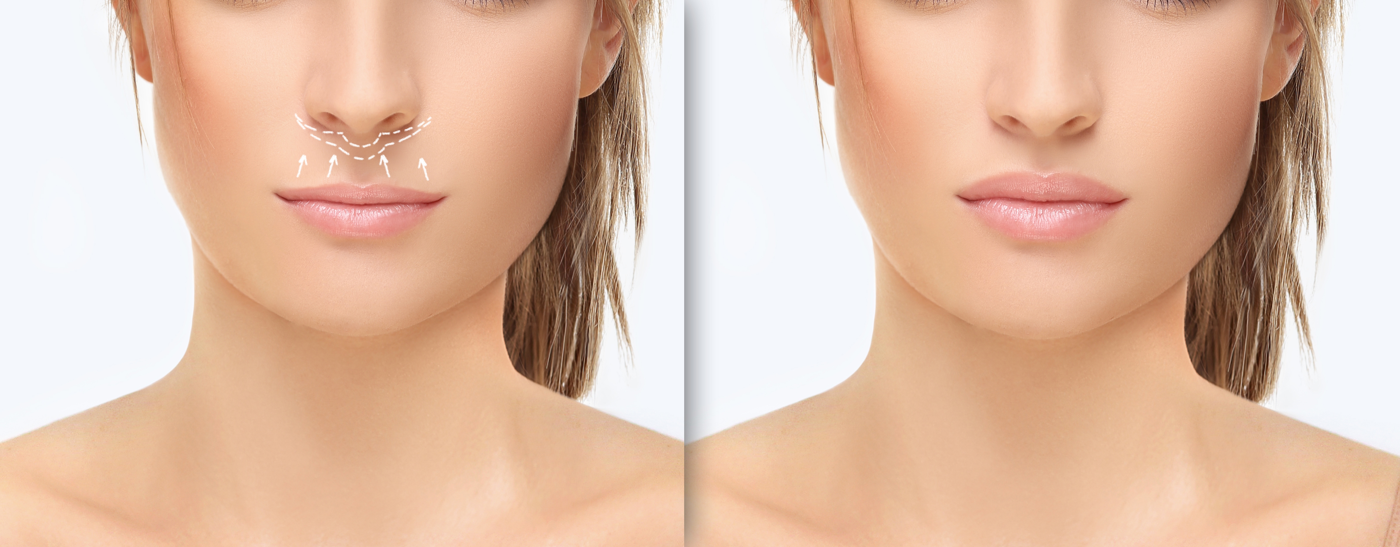 Verbeter het lipvolume Verbeter het lipvolume